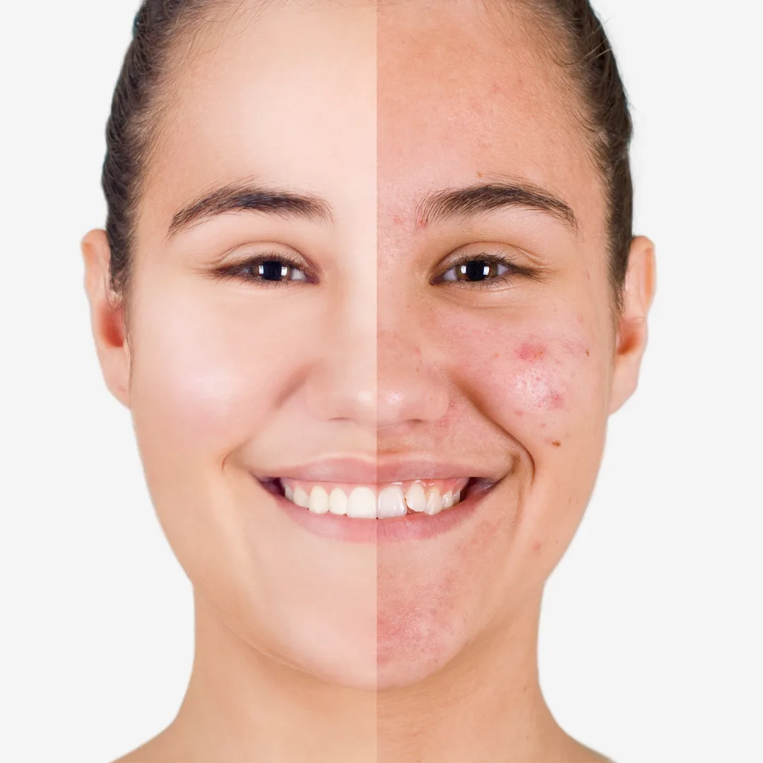 Sérum purifiant peau nette